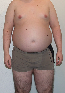 dicker Bauch