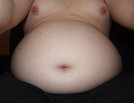 Speckbauch