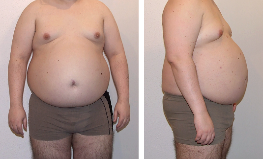 fetter Bauch