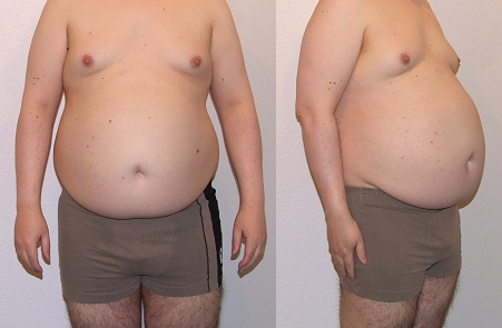 dicker Mann mit Mastbauch